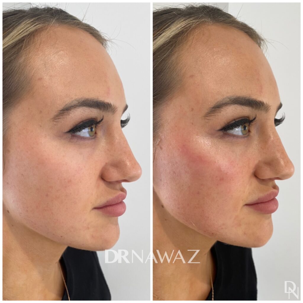 Beefore and After Treatment Results at Dr Nawaz Aesthetic Clinic