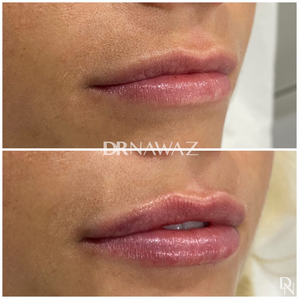 Treatment Results at Dr Nawaz Aesthetic Clinic