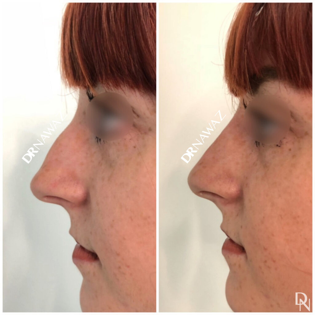 Results Dr Nawaz Aesthetic Clinic