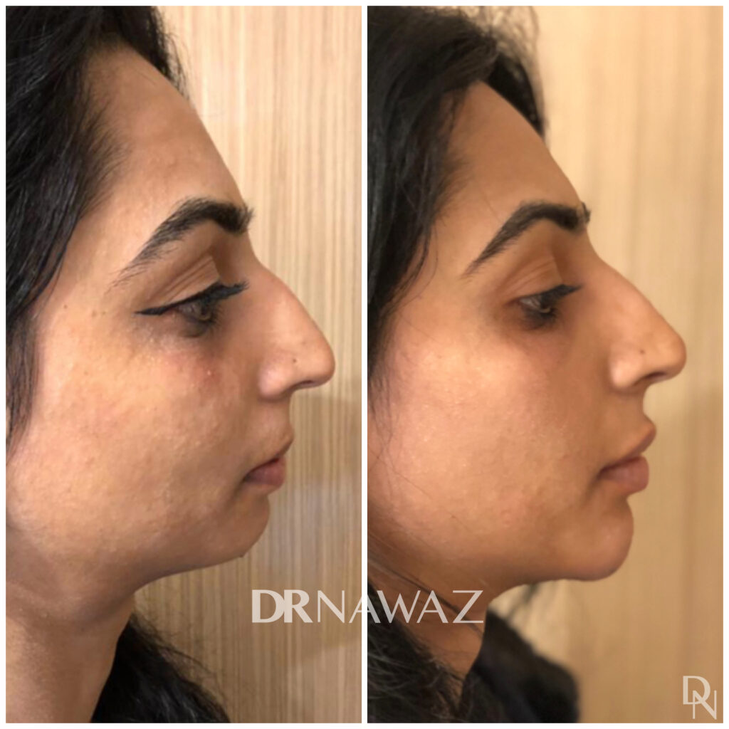 Nose Treatment Results Before and After Dr Nawaz Aesthetic Clinic