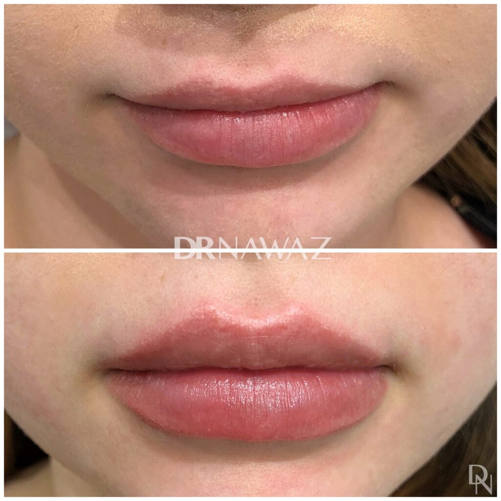 Lip Treatment Results Dr Nawaz Clinic