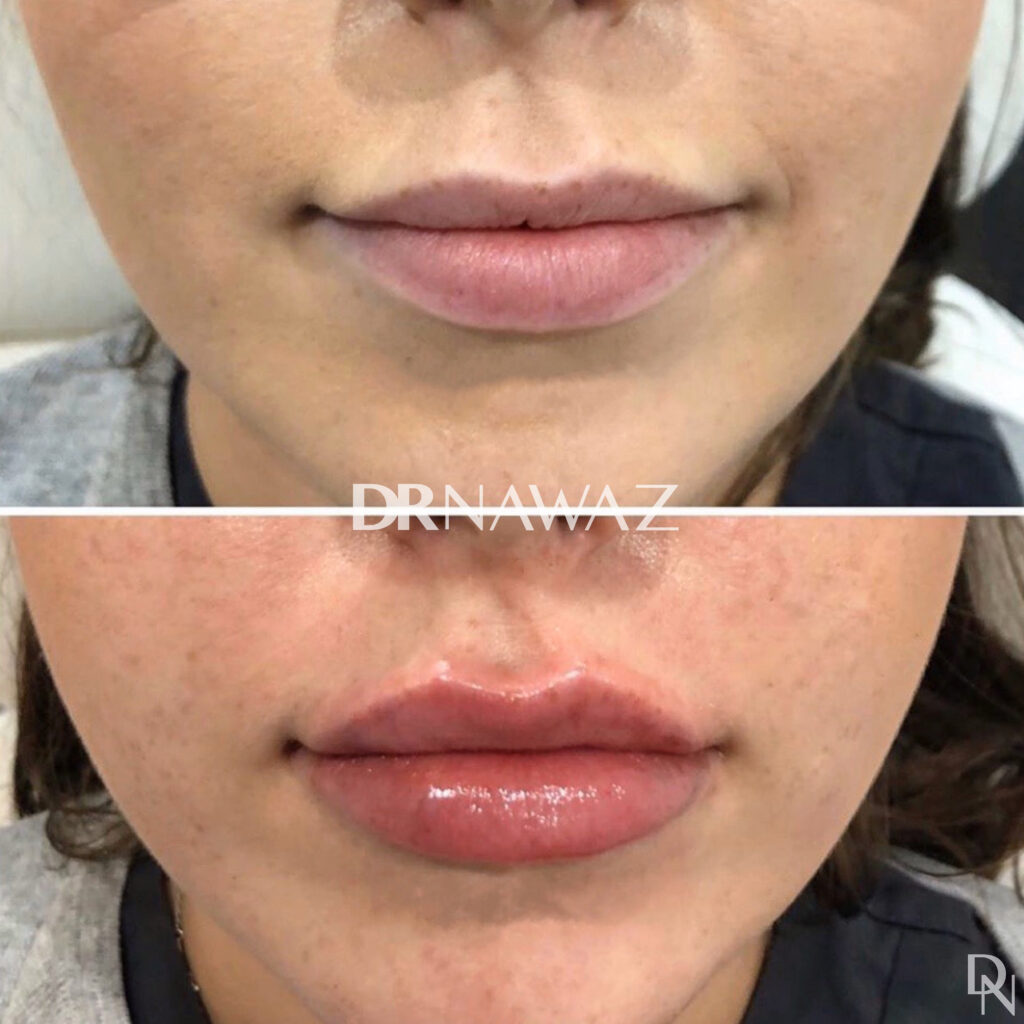 Lip Enhancement Treatment Dr Nawaz Aesthetic Clinic