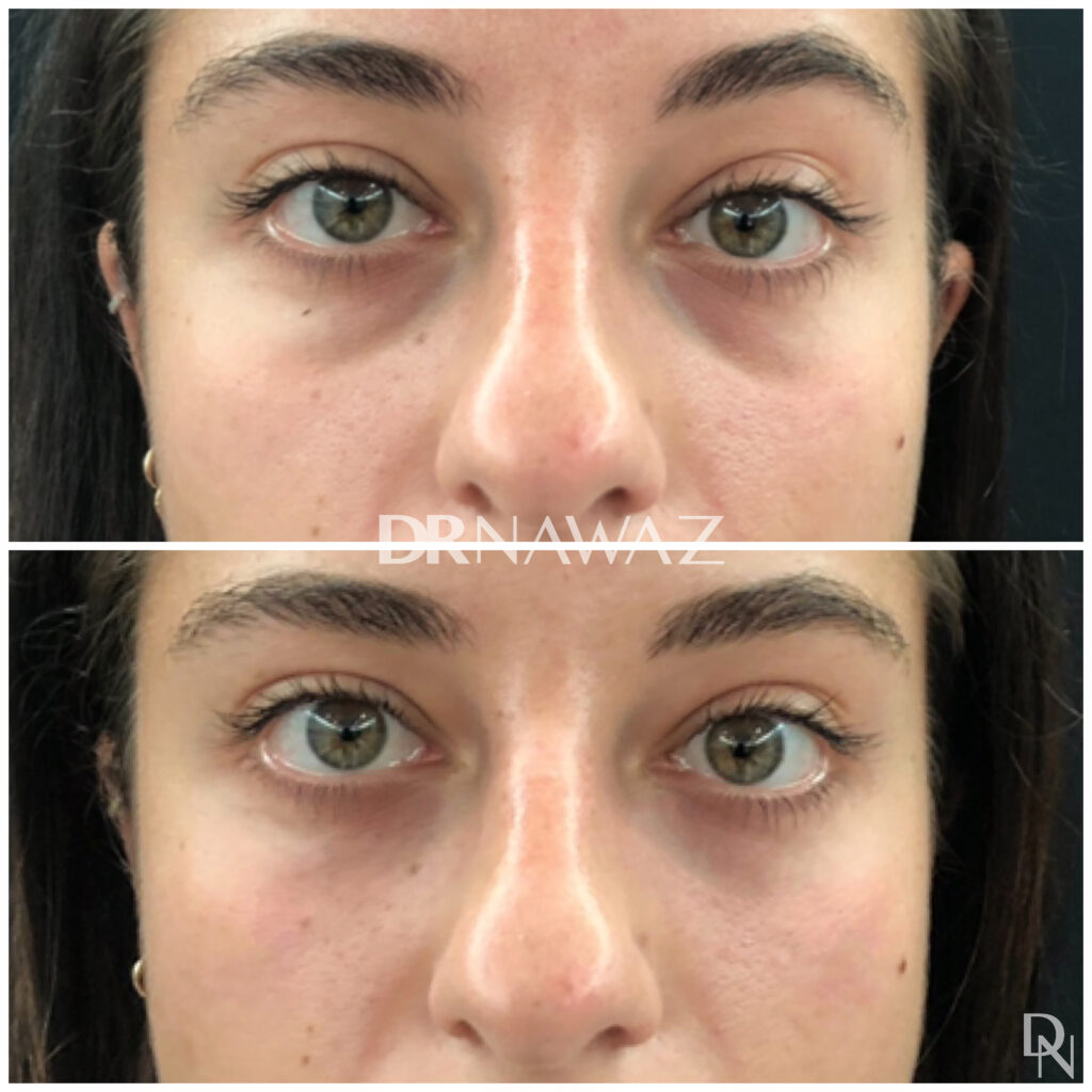 Tear Trough Filler Treatment Dr Nawaz