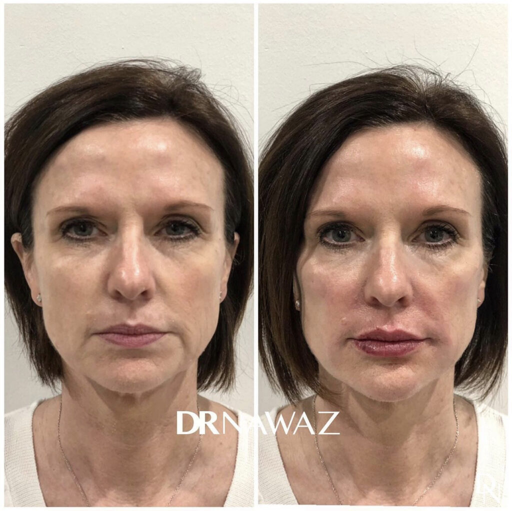 Before/After Treatment Results at Dr Nawaz Aesthetic Clinic