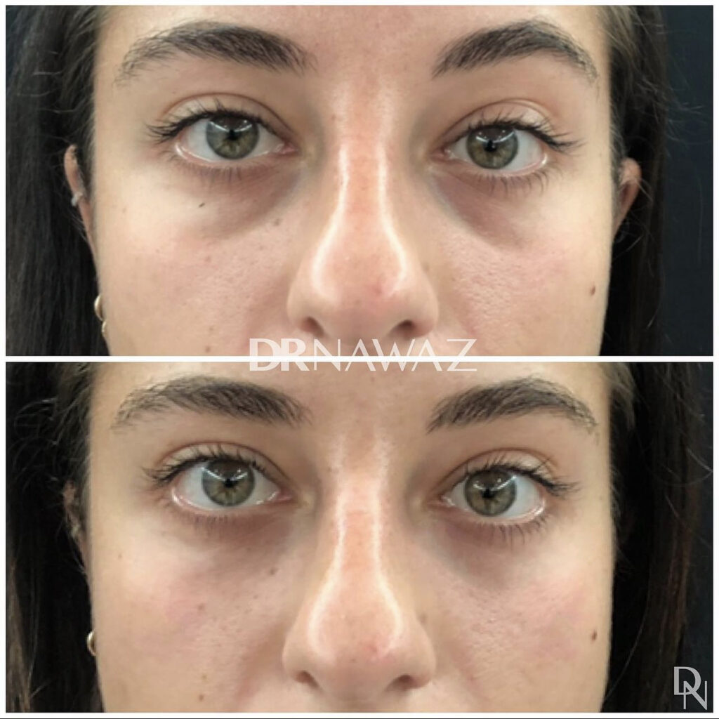 Results at Dr Nawaz Aesthetic Clinic