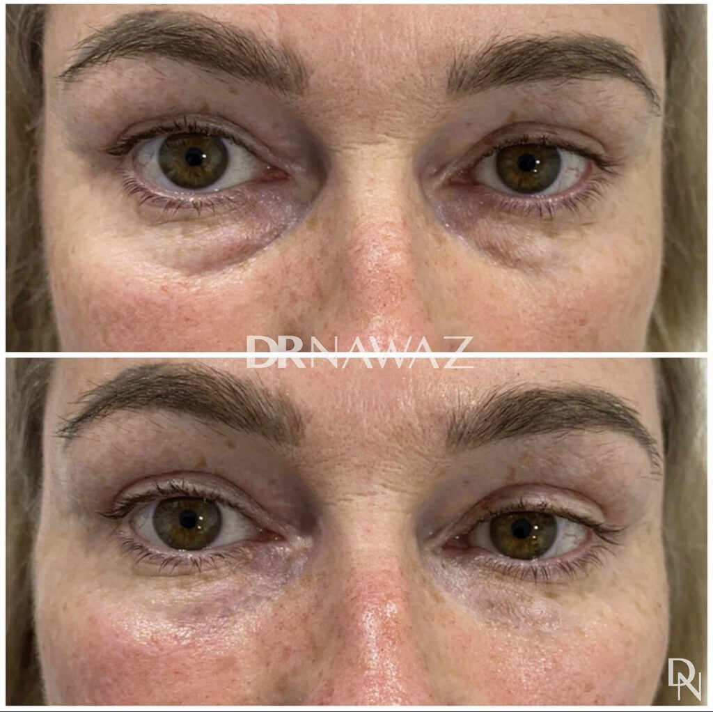 Treatment Results at Dr Nawaz Aesthetic Clinic