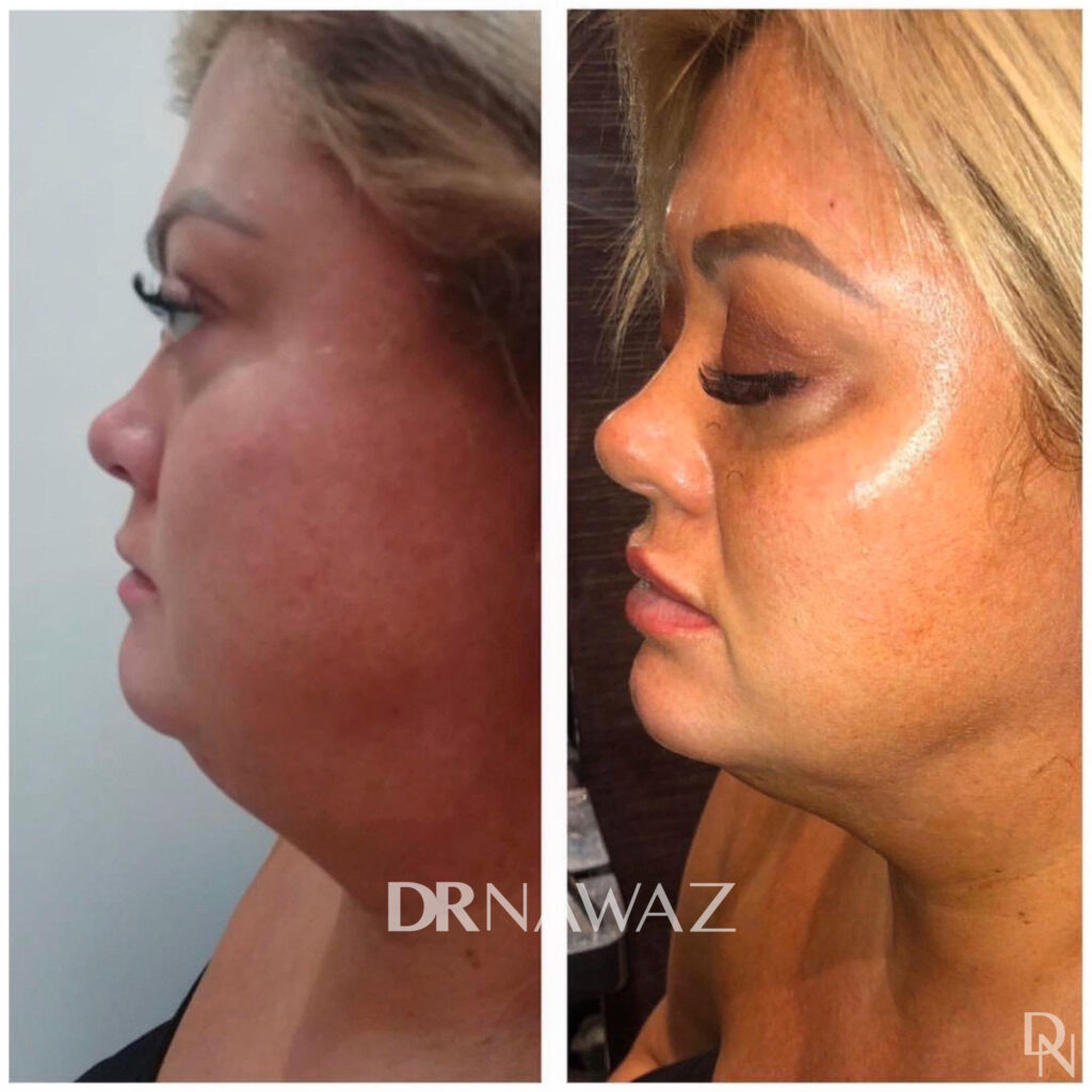 Jawline Slimming / Masseter Reduction Treatment Dr Nawaz Aesthetic Clinic