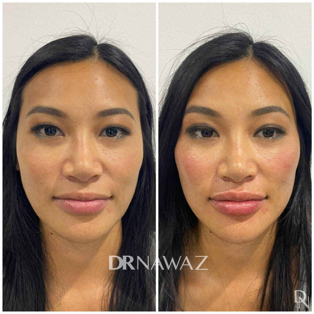 Before and After Treatment Results by Dr Nawaz London Aesthetic Clinic