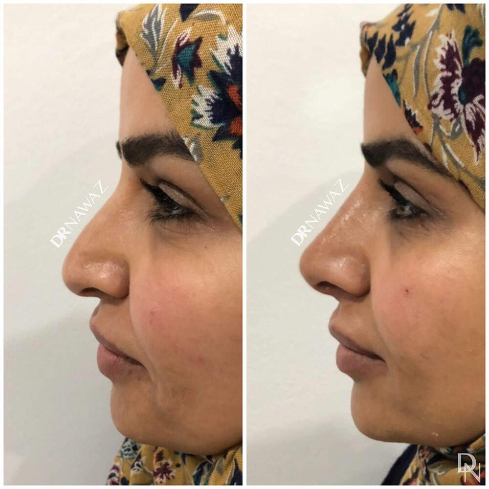 Aesthetic treatment before and after result Dr Nawaz Skin Clnic London Harley Street