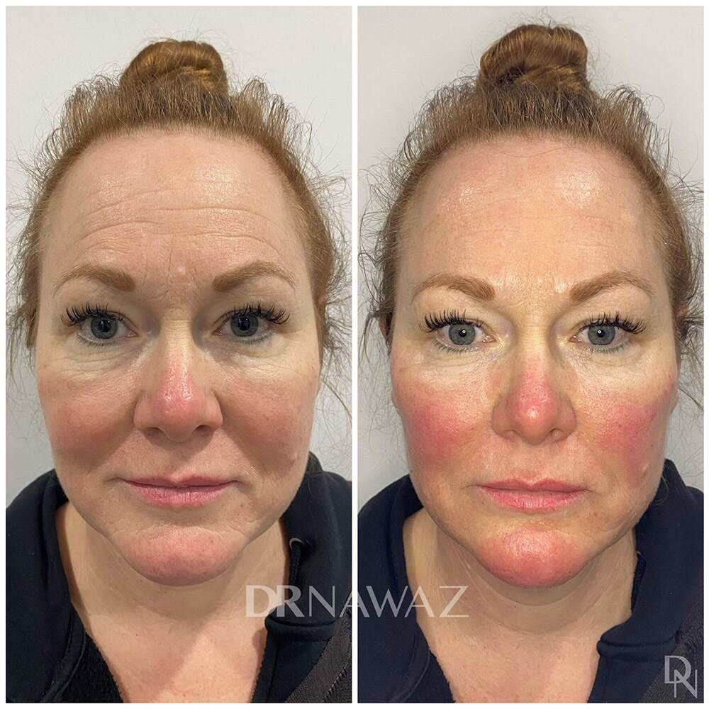 Before and After results performed at Dr Nawaz Aesthetic Clinic London